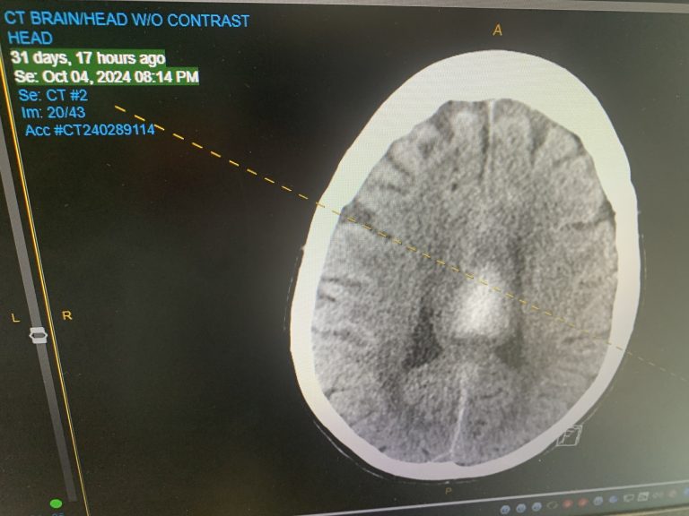 Using ChatGPT to assess CT scans of the brain